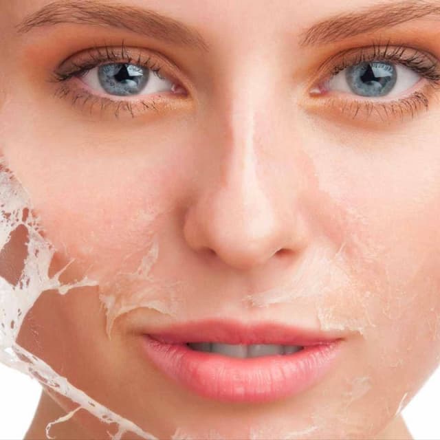 Irines Acne Care Membership at Irines Spa in Roanoke, VA